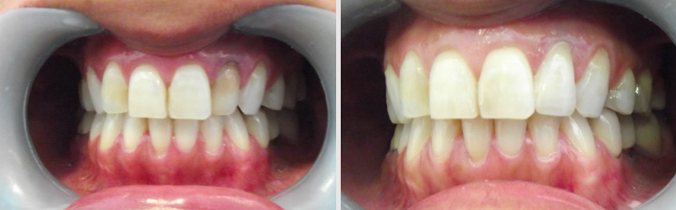 affrodable porcelain crowns