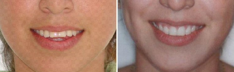 affrodable porcelain crowns