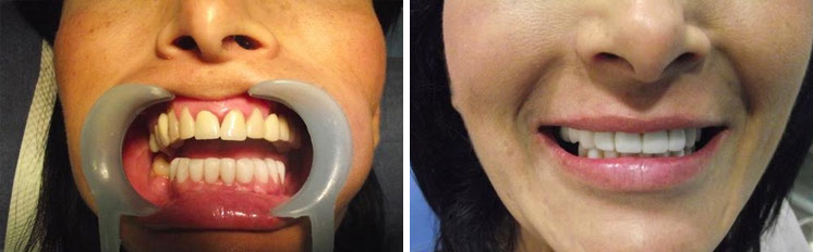 affrodable porcelain crowns